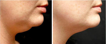 A before and after photo of a woman 's neck and chin.