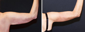 A before and after photo of a woman 's arms.