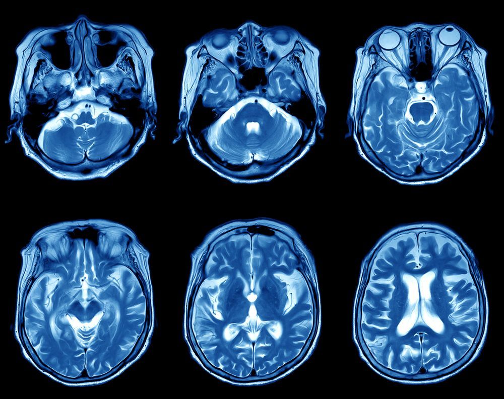 MRI brain scans
