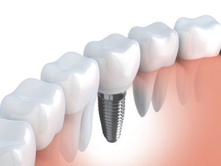 illustration of dental implant, dental implant timeline blog