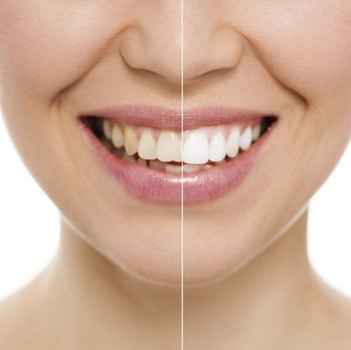 teeth whitening comparison, DIY teeth whitening blog