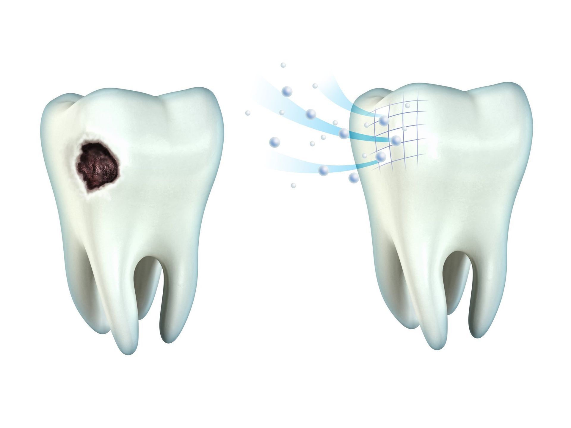 an illustration of a tooth before and after being cleaned