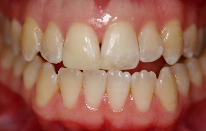 Patient's teeth after bonding