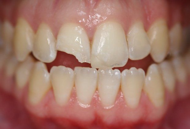 Patient's teeth before bonding