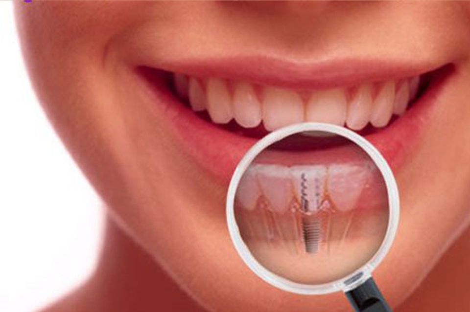 impianto dentale titanio