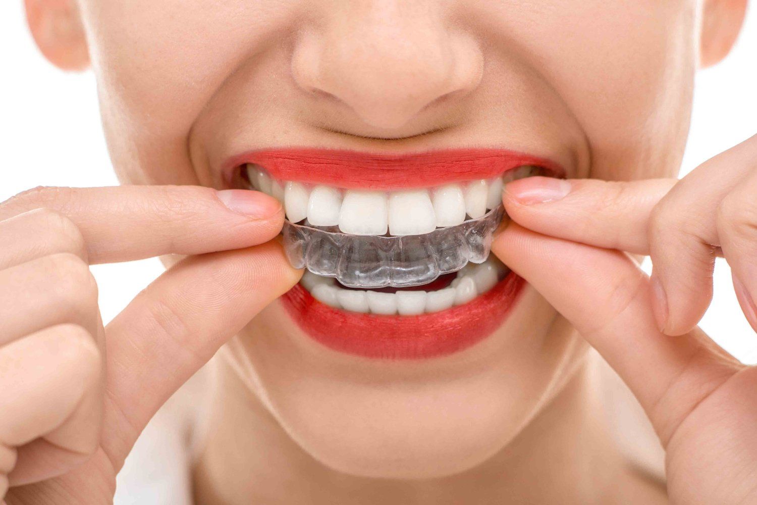 apparecchio invisalign
