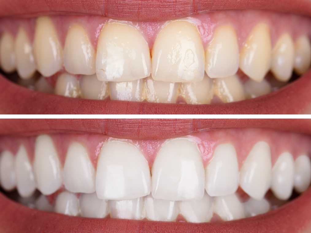 teeth whitening in la palma ca before and after