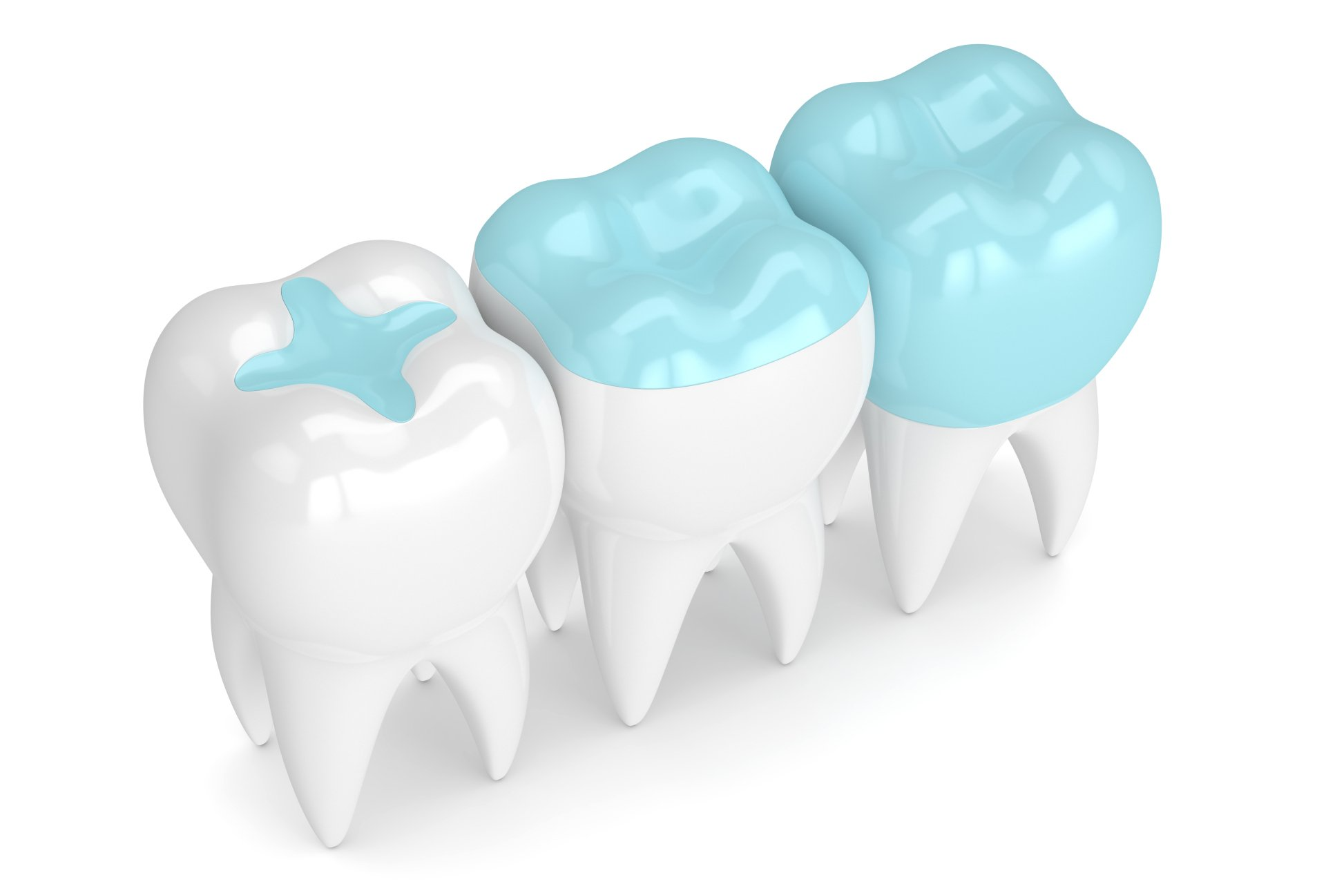 dental sealant model