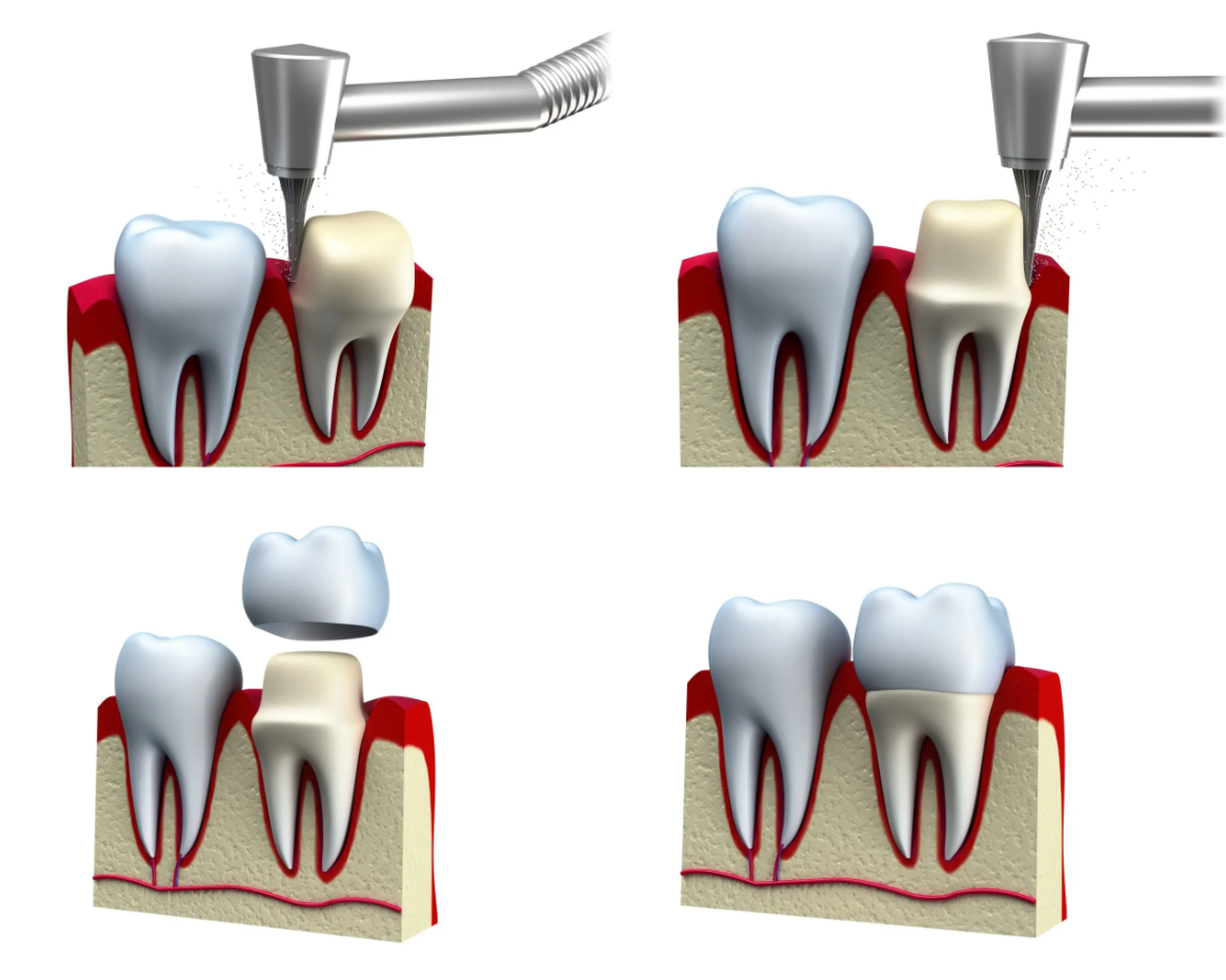 Dental crown model