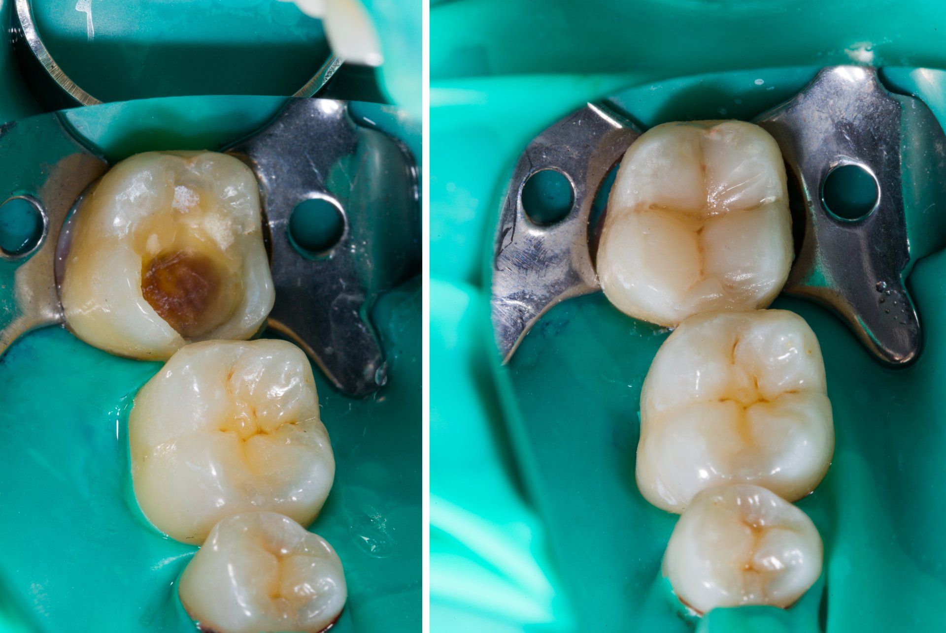 tooth bonding before and after