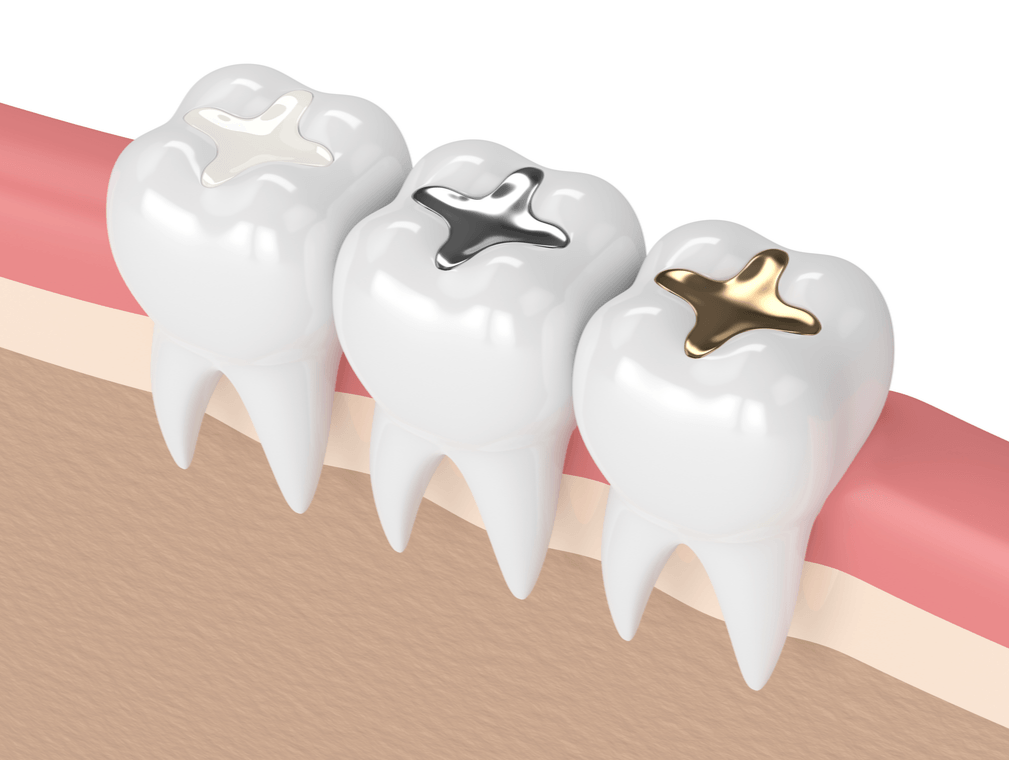 tooth filling model