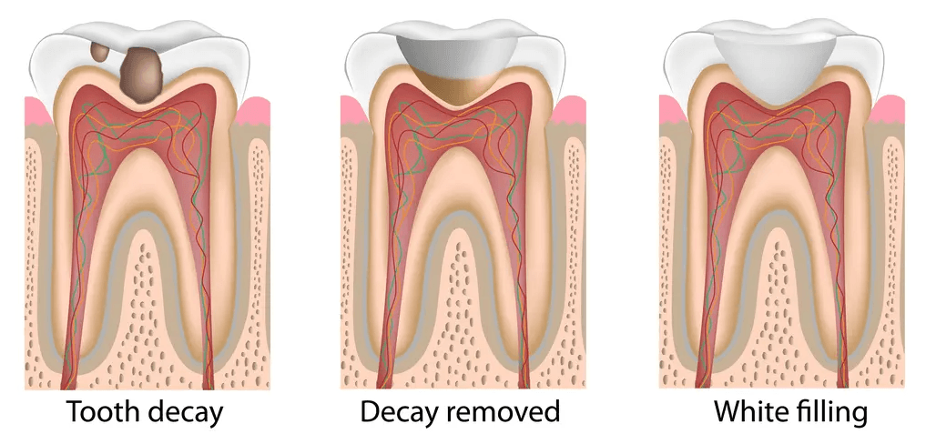 tooth filling model