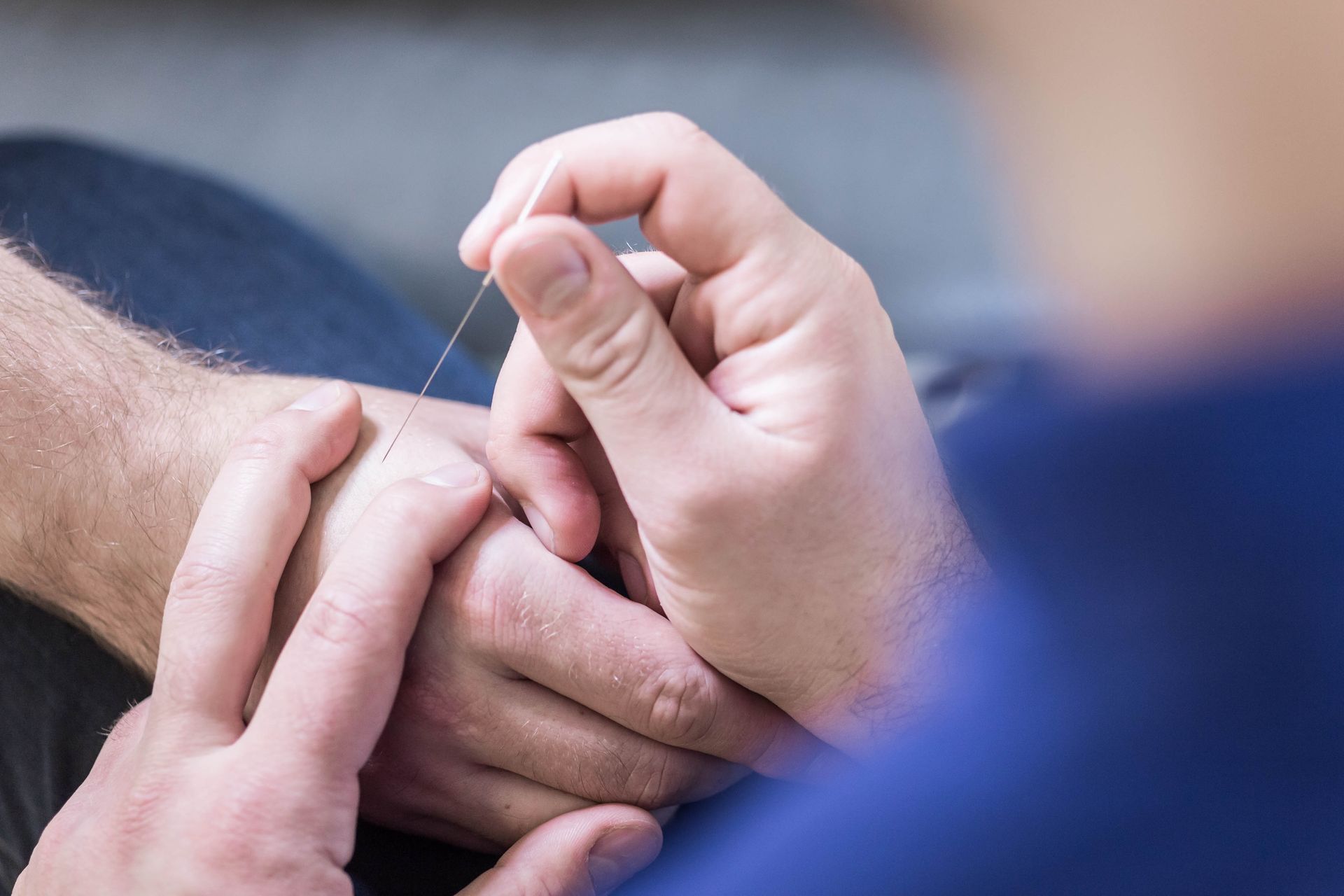 A person is getting acupuncture on their hand.