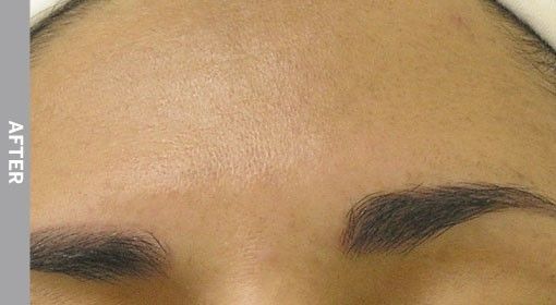 Close-up of a person's forehead and eyebrows. The eyebrows are dark and well-defined. Skin appears smooth.