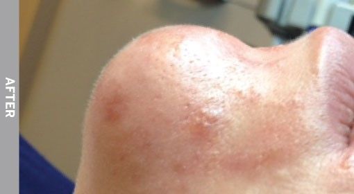 Close-up of a person's skin with visible acne scars and bumps after a treatment.