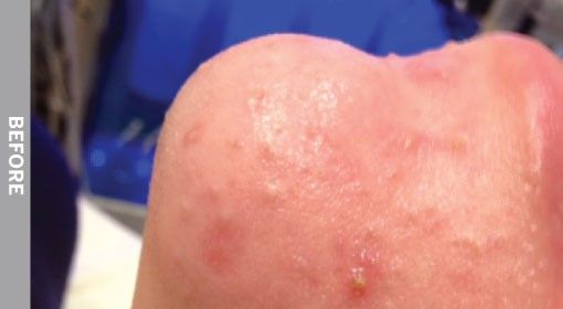 Close-up of skin on knee before treatment, showing small bumps and redness.