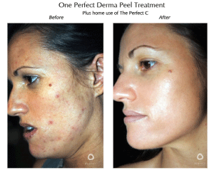 Before and after photos of a woman's face, showing skin improvement after a Derma Peel treatment.
