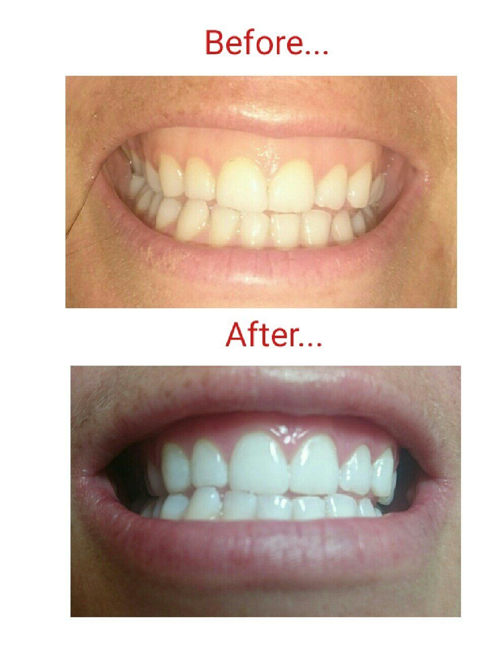 10 shades lighter before and after teeth whitening