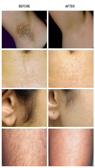 Laser Hair Removal