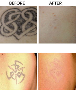 Tattoo Removal