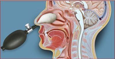 Cross-section of a head showing a nasal cavity, with a device inflating a balloon-like structure in the nose.