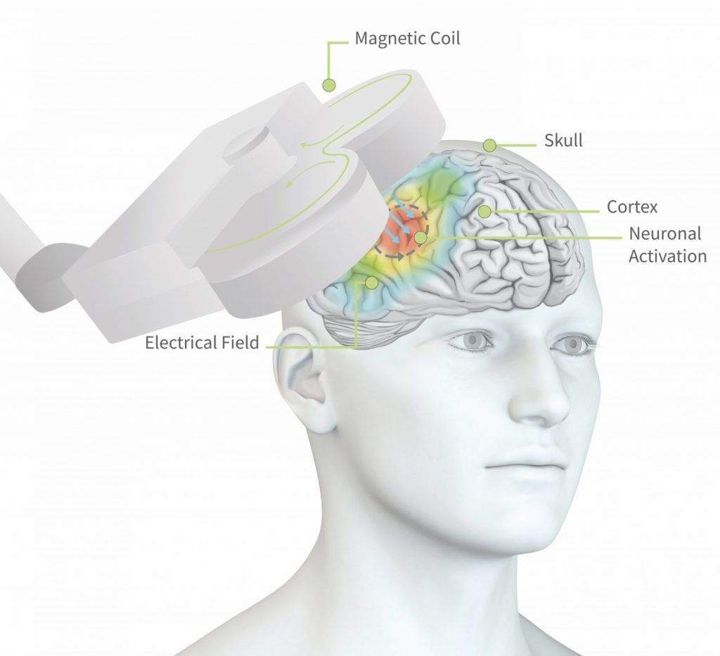 Person undergoing transcranial magnetic stimulation; magnetic coil near head, stimulating brain.