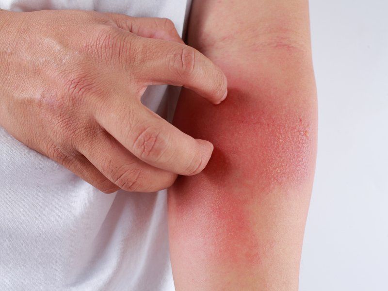 Dermatite atopica ed eczemi