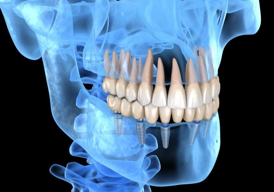 rappresentazione chirurgia implantare