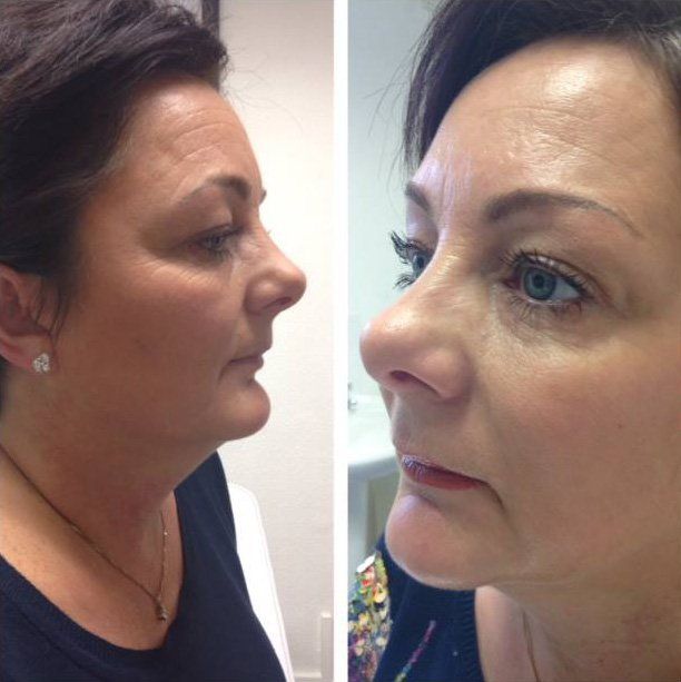 Cosmetic Surgery Before and after 1