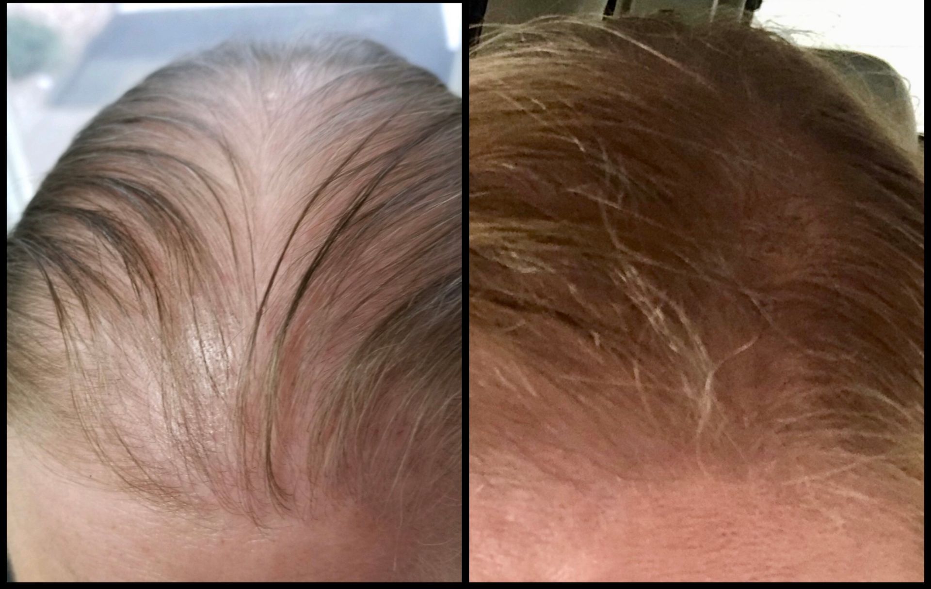 Hair Restoration