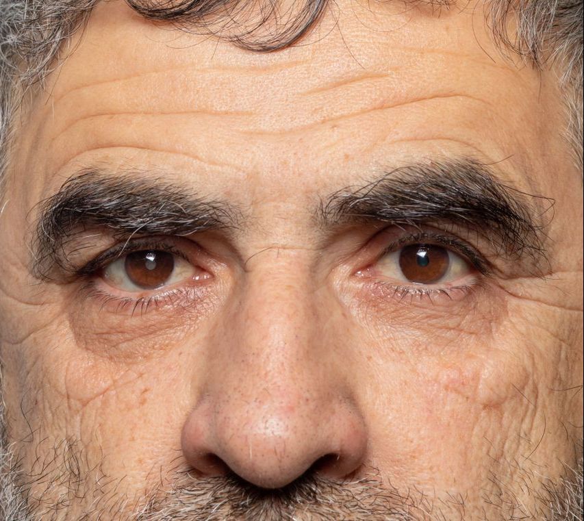 O que causa o glaucoma