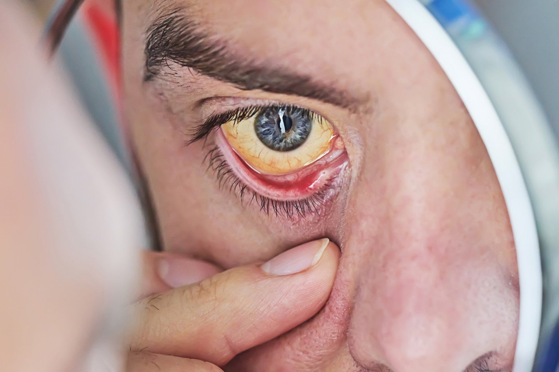 sintomas do tumor ocular sintomas do tumor ocular