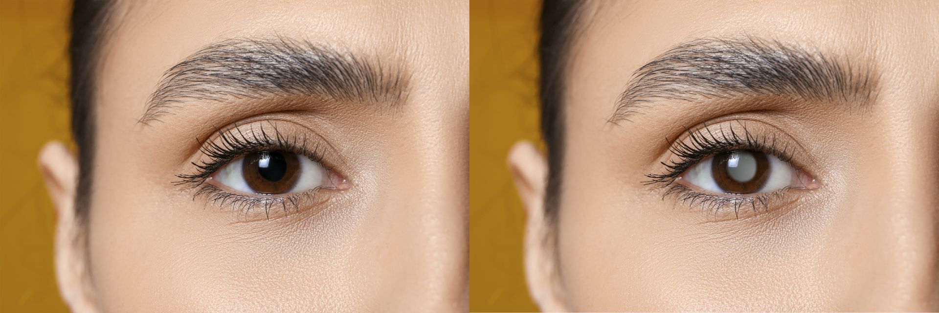 Glaucoma é hereditário?