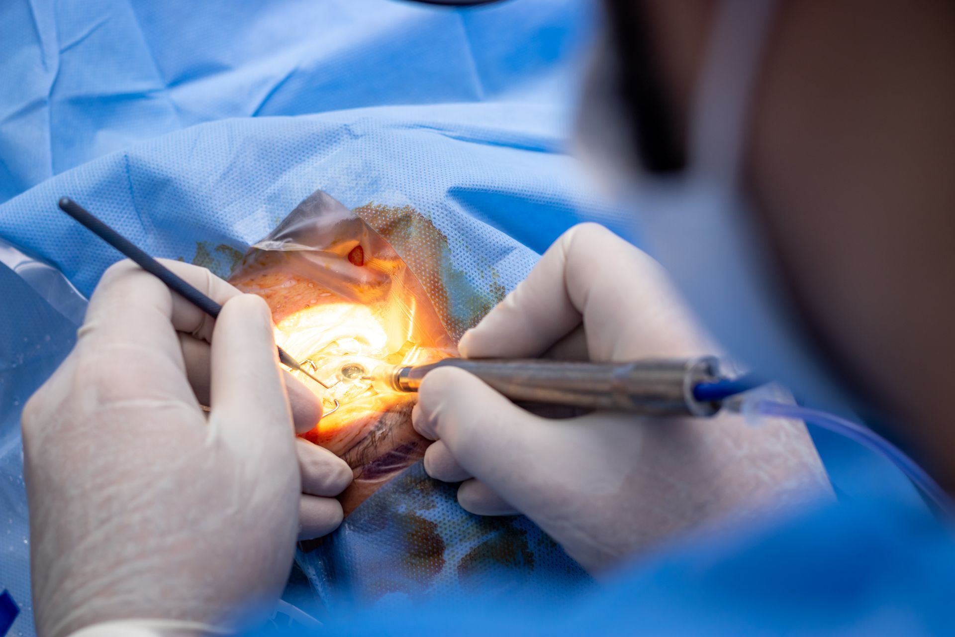 É possível operar os dois olhos no mesmo dia na cirurgia de catarata?