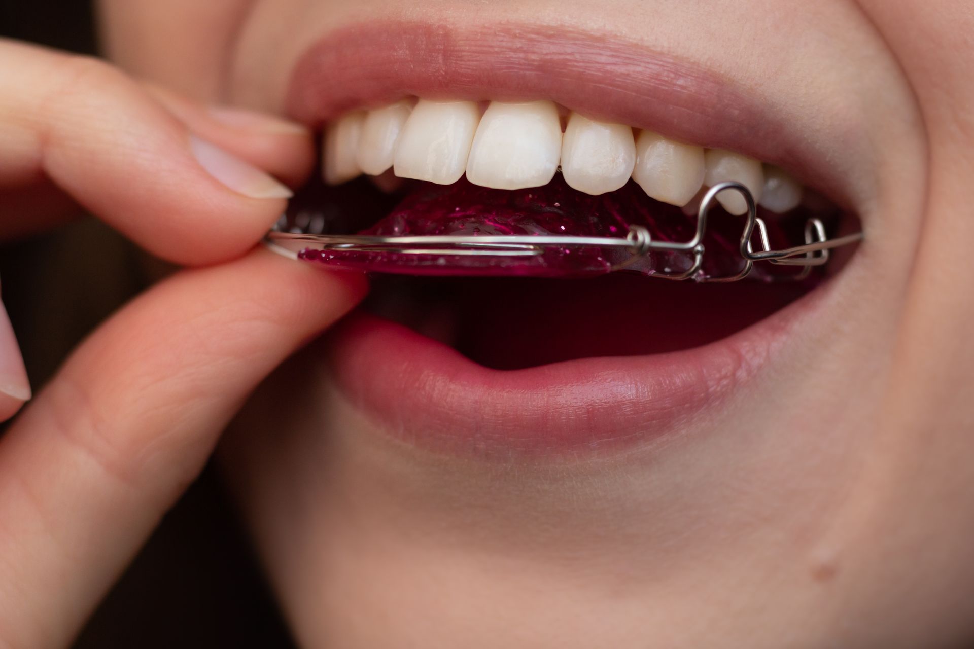 Close-up of a person's mouth inserting a red and silver retainer into their teeth.