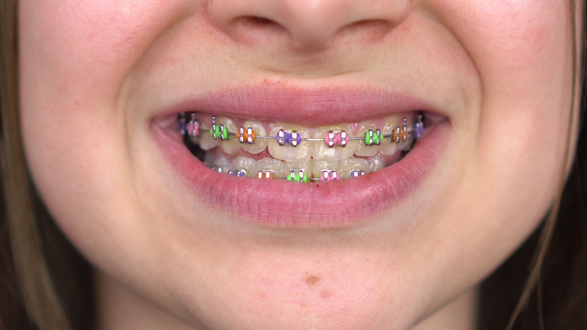 Close-up of a person's smiling mouth showing teeth with colorful braces.