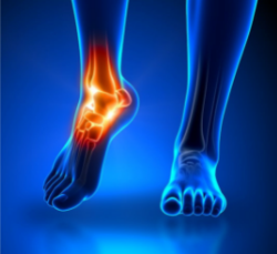 Foot and Ankle - Dr Mark Horsley, an Orthopaedic Surgeon Newtown