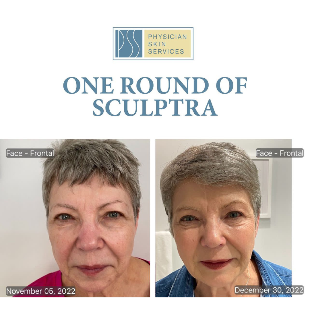 Sculptra treatment results at Physician Skin Services