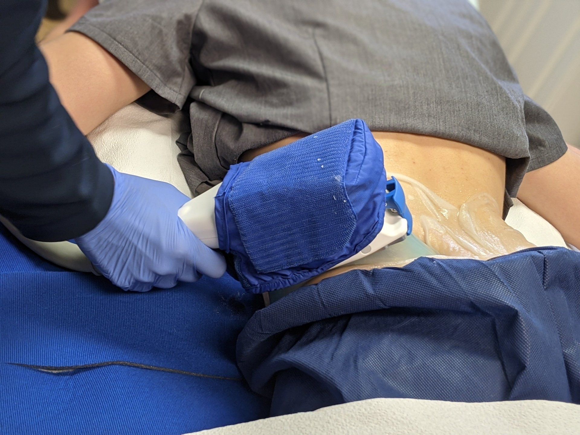 coolsculpting at Physician Skin Services