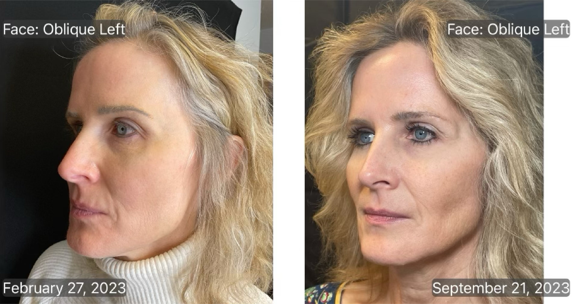 PSS Sculptra patient before and after