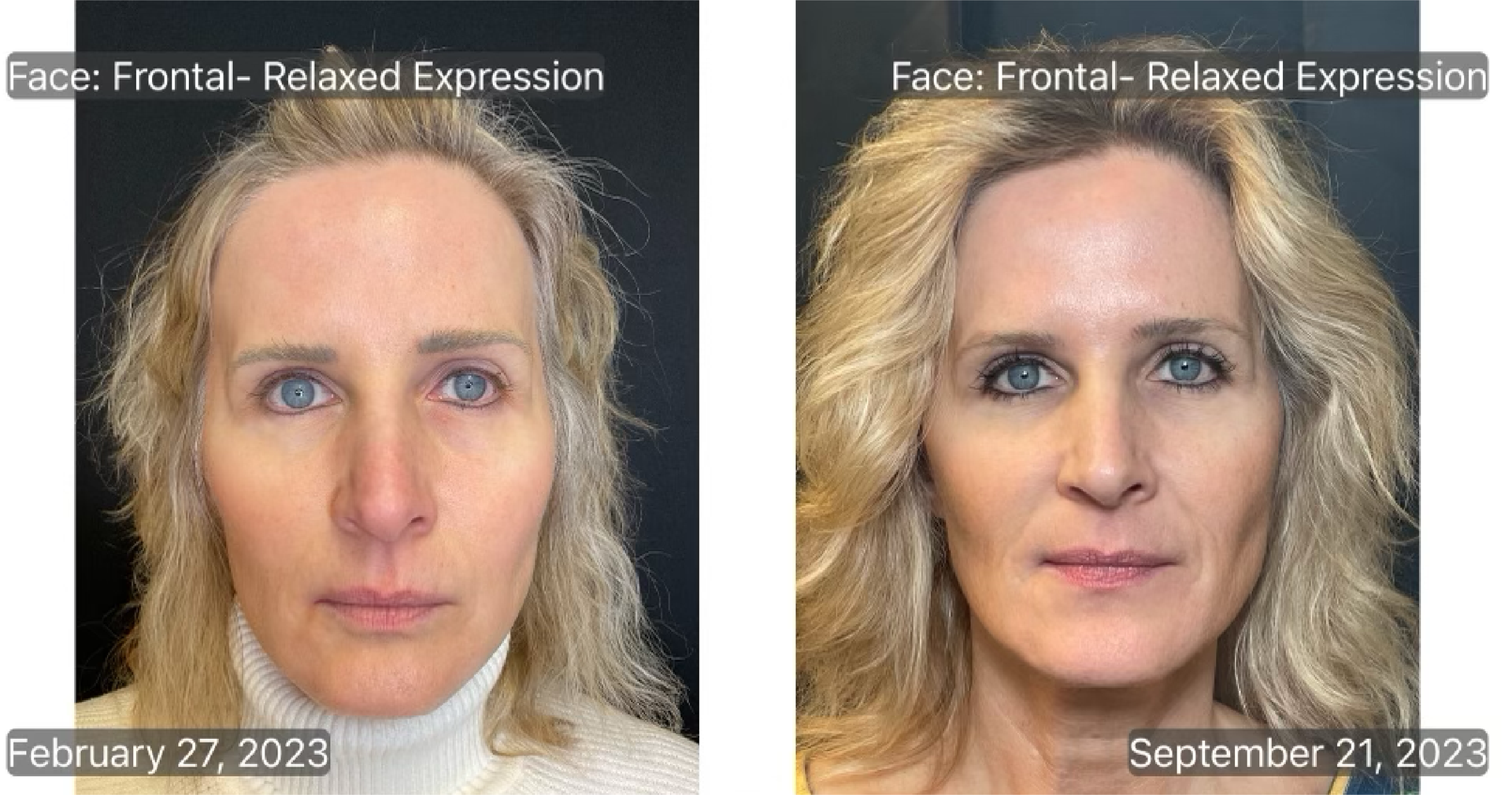 Discover how Sculptra at Physician Skin Services can restore volume, stimulate collagen and more