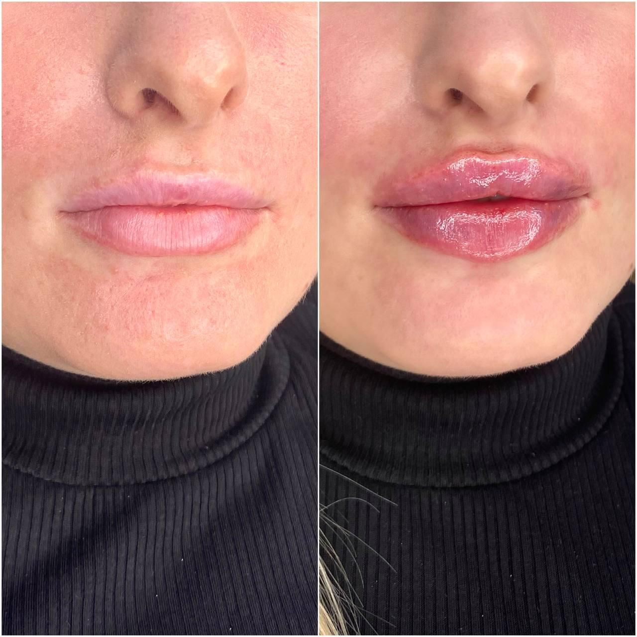Ein Vorher-Nachher-Foto der Lippen einer Frau.