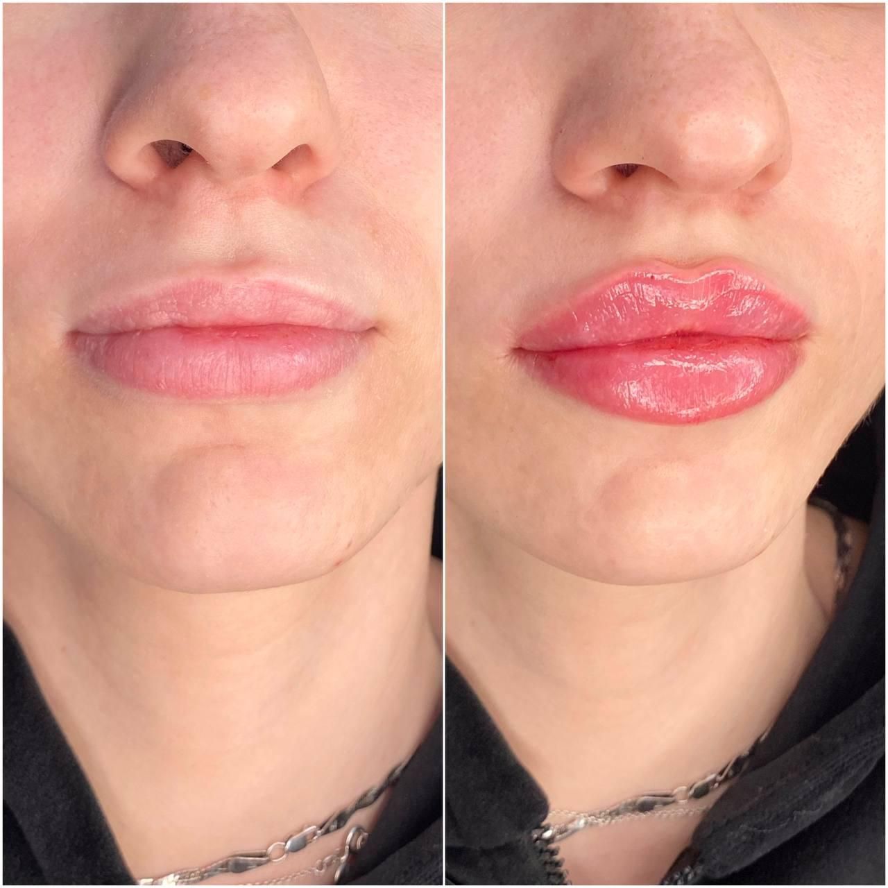 Ein Vorher-Nachher-Bild der Lippen einer Frau mit einer Halskette