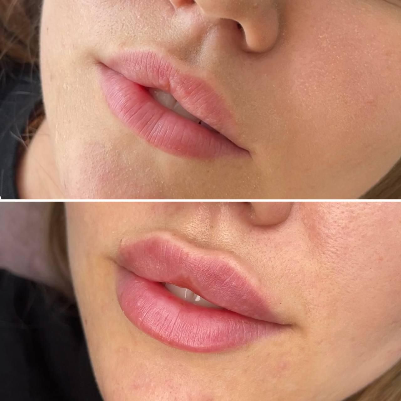 Ein Vorher-Nachher-Bild der Lippen einer Frau.