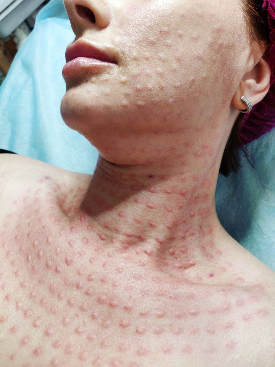 Eine Nahaufnahme vom Hals und der Brust einer Frau mit roten Flecken darauf.