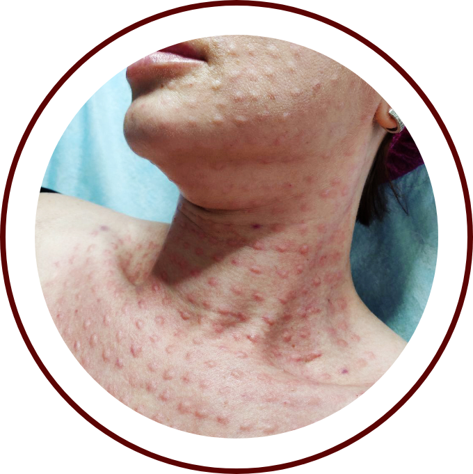 Der Hals einer Frau hat viele rote Flecken