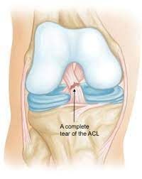 ACL injury, get help from Apache Brave sports therapy in Coventry to you back to sport.