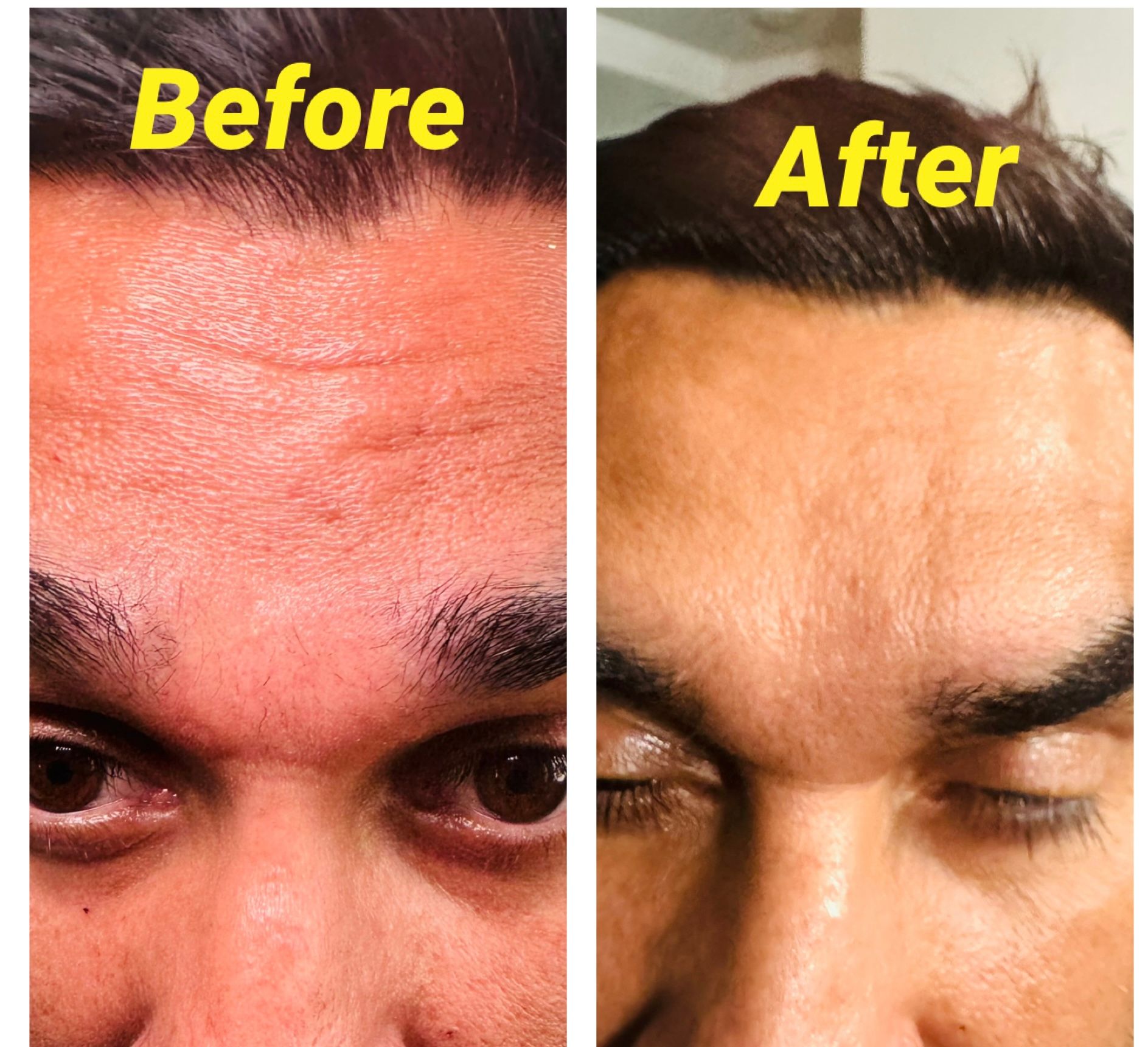 Comparison of a man's forehead: 