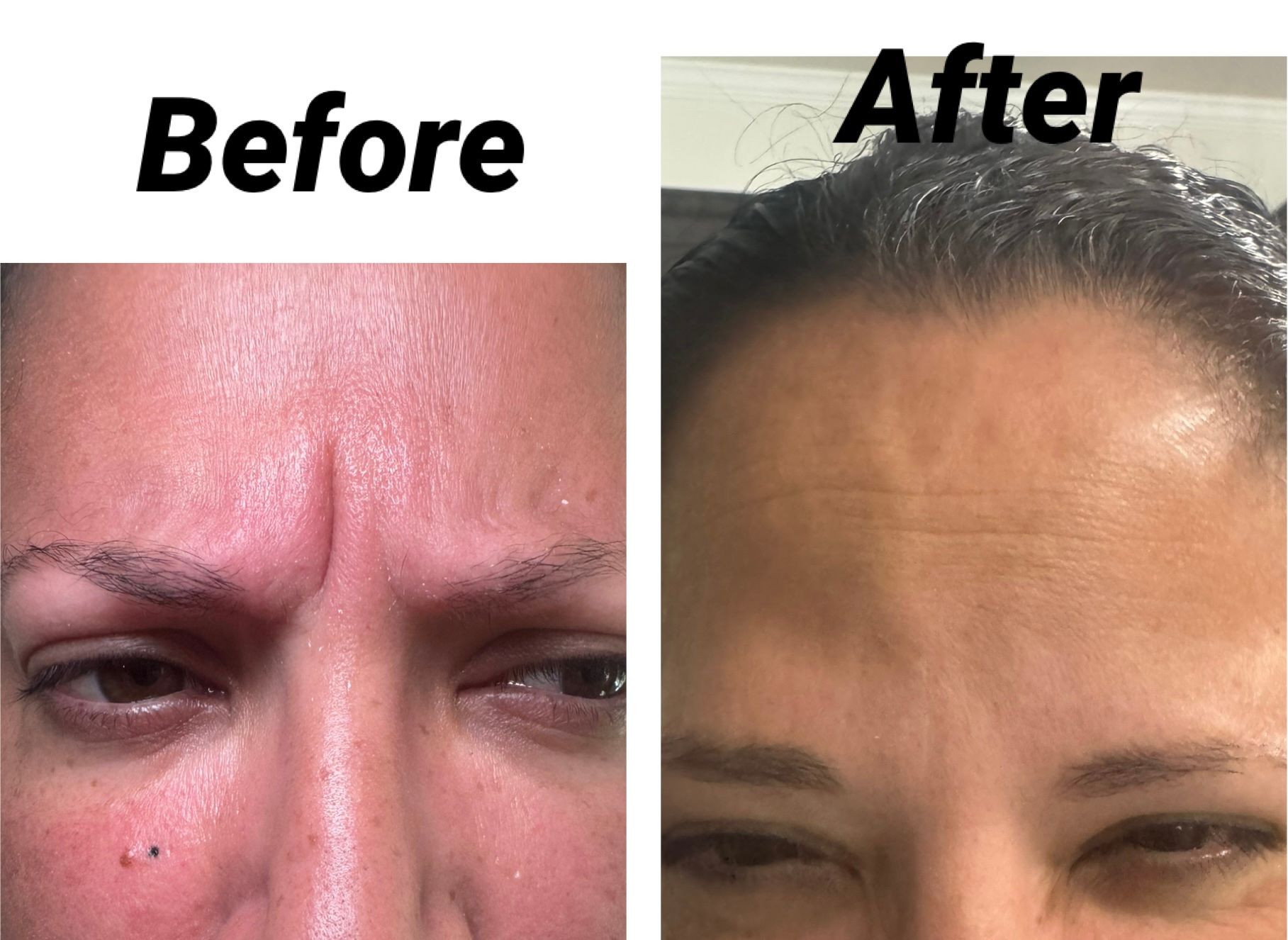 Before and after view of forehead, showing wrinkle reduction.