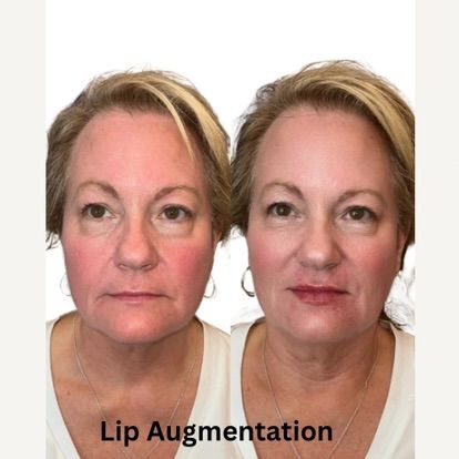 Side-by-side photos of a woman. The right image shows fuller lips, illustrating lip augmentation.